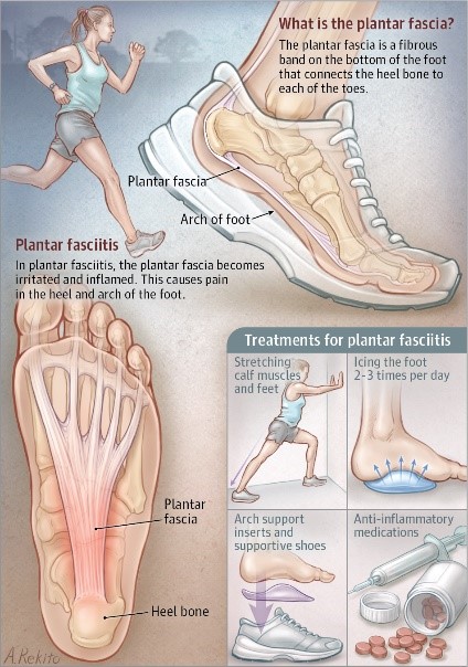 plantar fasciitis explained, home remedies and treatment